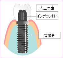 インプラントとは